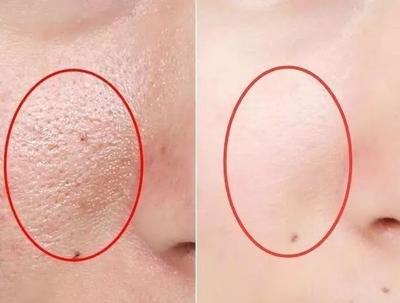 如何使毛孔变细腻