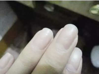 下眼睑发白是怎么回事