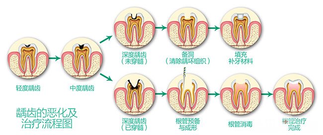 蛀牙怎么治疗