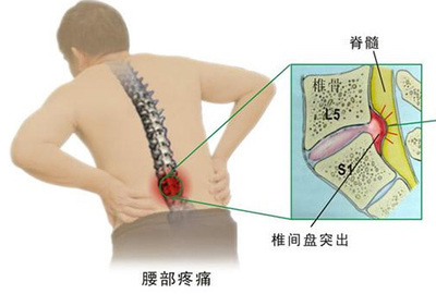 腰椎间盘突出怎么治疗最好