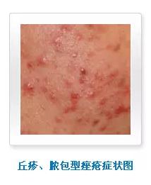 痘痘一直有脓包怎么办
