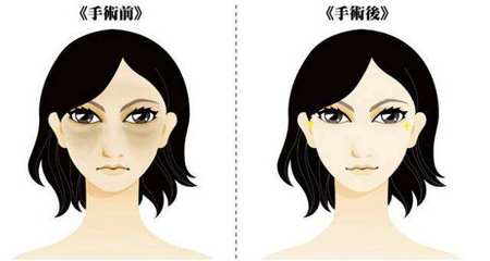 抽脂祛眼袋多少钱