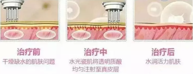 有痘痘可以打玻尿酸吗