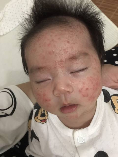 新生儿痤疮消退图片
