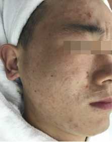 为什么脸上有痘痘男士