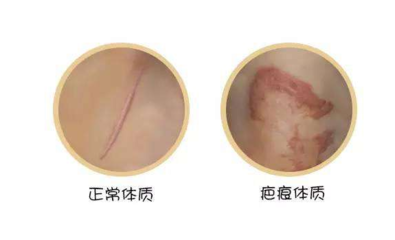 怎么确定是不是疤痕体质