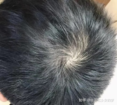 天天掉头发是怎么回事