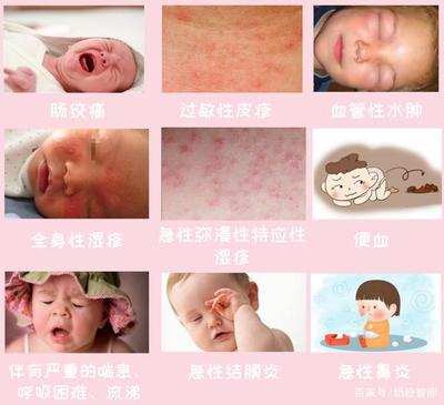 荨麻疹可以喝奶粉吗