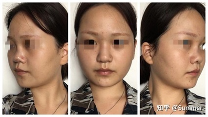 隆鼻怎样