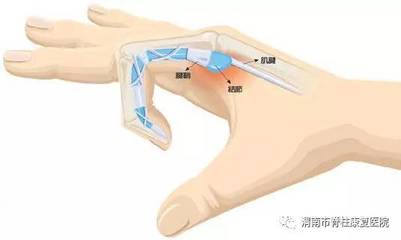 手关节腱鞘炎怎么治疗