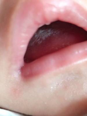 宝宝舌苔中间缺一块