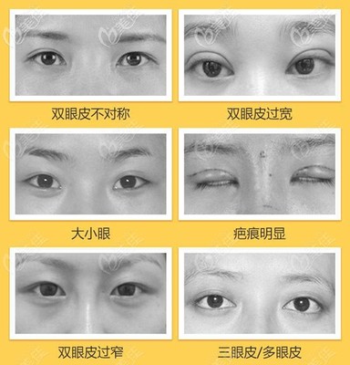 为什么双眼皮会变成三眼皮