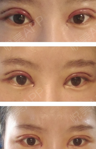 全切双眼皮恢复过程