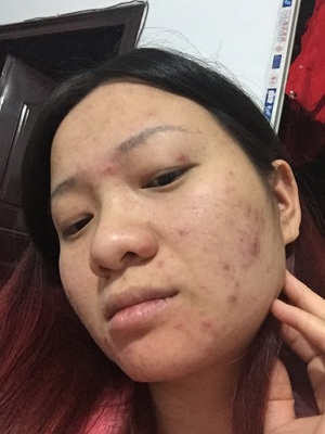 痘痘老是不好_好烦