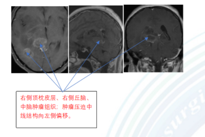 脑瘤怎么治疗最好