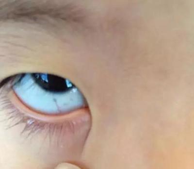 宝宝眼白上有灰色斑块