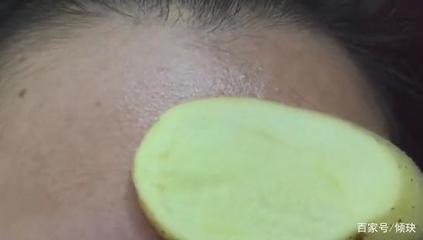 长痘痘能用土豆