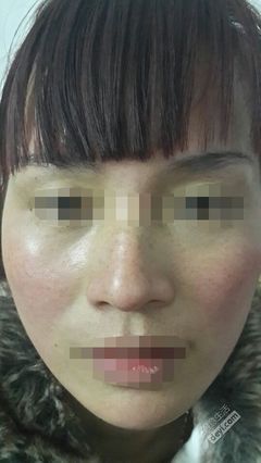 祛斑 论坛