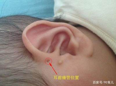 耳朵有个小孔是怎么回事