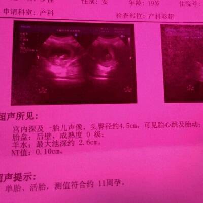 查白带可以查出怀孕吗