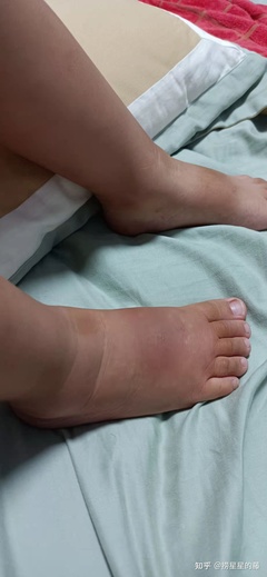 脚背疼肿是怎么回事