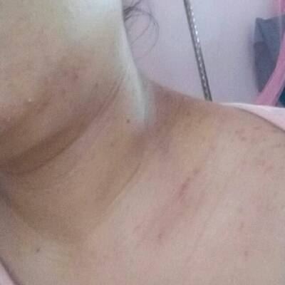 下巴脖子长痘痘怎么处理