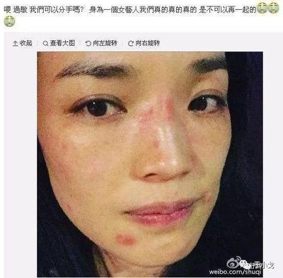 痘痘严重到快烂脸了