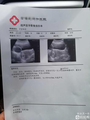 怀孕卵巢囊肿怎么办