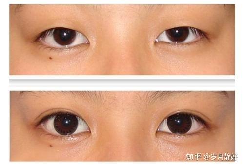 双眼皮忌口多久
