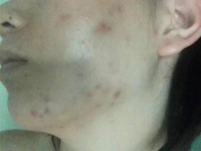 光打水光针长痘痘