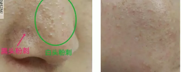 粉瘤和痘痘的区别