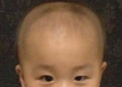 宝宝左侧头骨凸起图片