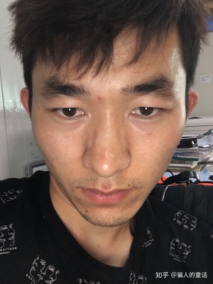 腮部反复长痘痘