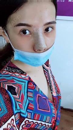 隆鼻打几天消炎针
