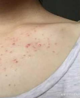 胸前总是长痘痘是什么原因