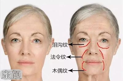 瘦脸针为什么会凹陷