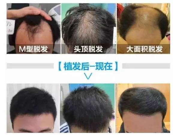 毛发种植大概需要多少钱