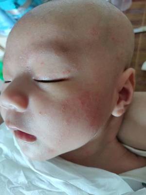 6个月宝宝出疹子症状