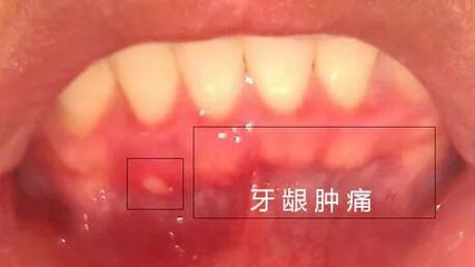 牙龈肿痛是怎么回事