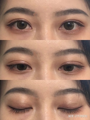 割双眼皮变窄