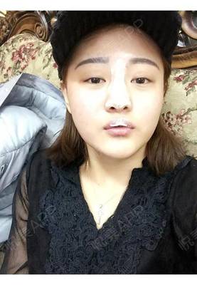水光针可以打鼻子吗