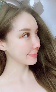 开眼角拆线后多久化妆