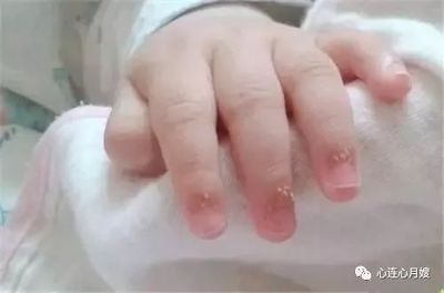 宝宝手倒刺缺什么营养