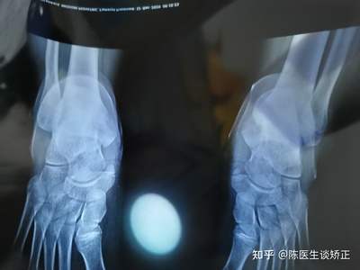 副舟骨怎么治疗最好