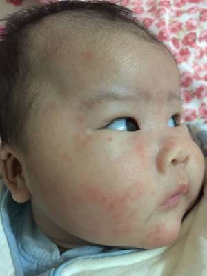 6个月宝宝出疹子症状