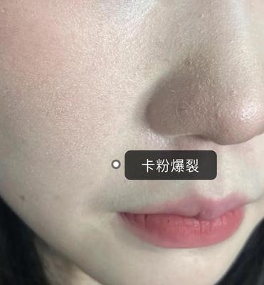 抢打痘痘