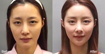 瘦脸针为什么会凹陷