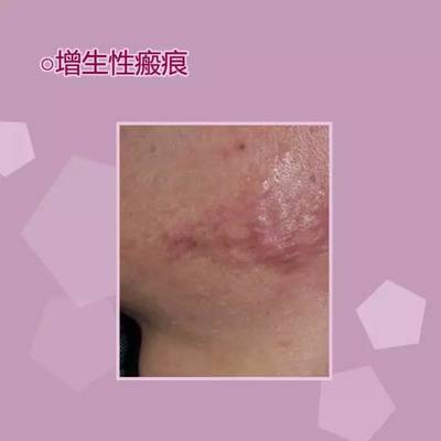 液态冷冻 痘痘