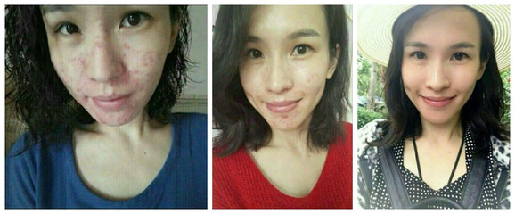 有什么祛痘印的好方法