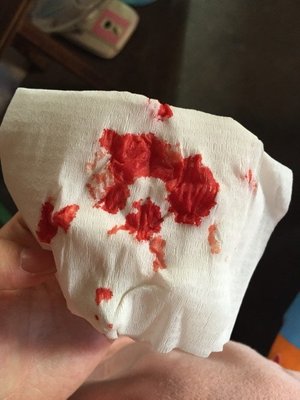 流鼻血有血块是怎么回事